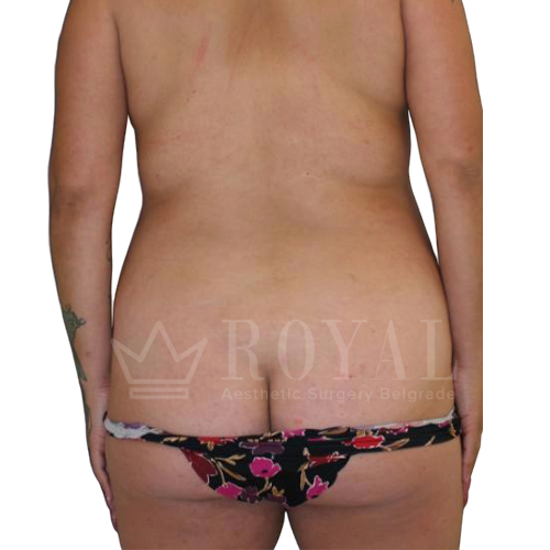 Estetska kirurgija | Prije i poslije