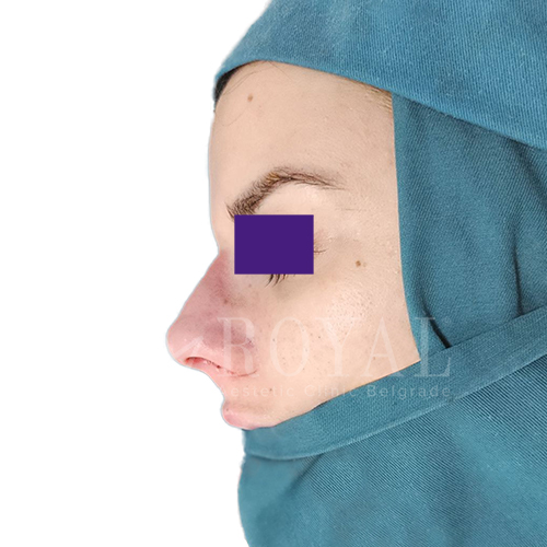 Estetska kirurgija | Prije i poslije