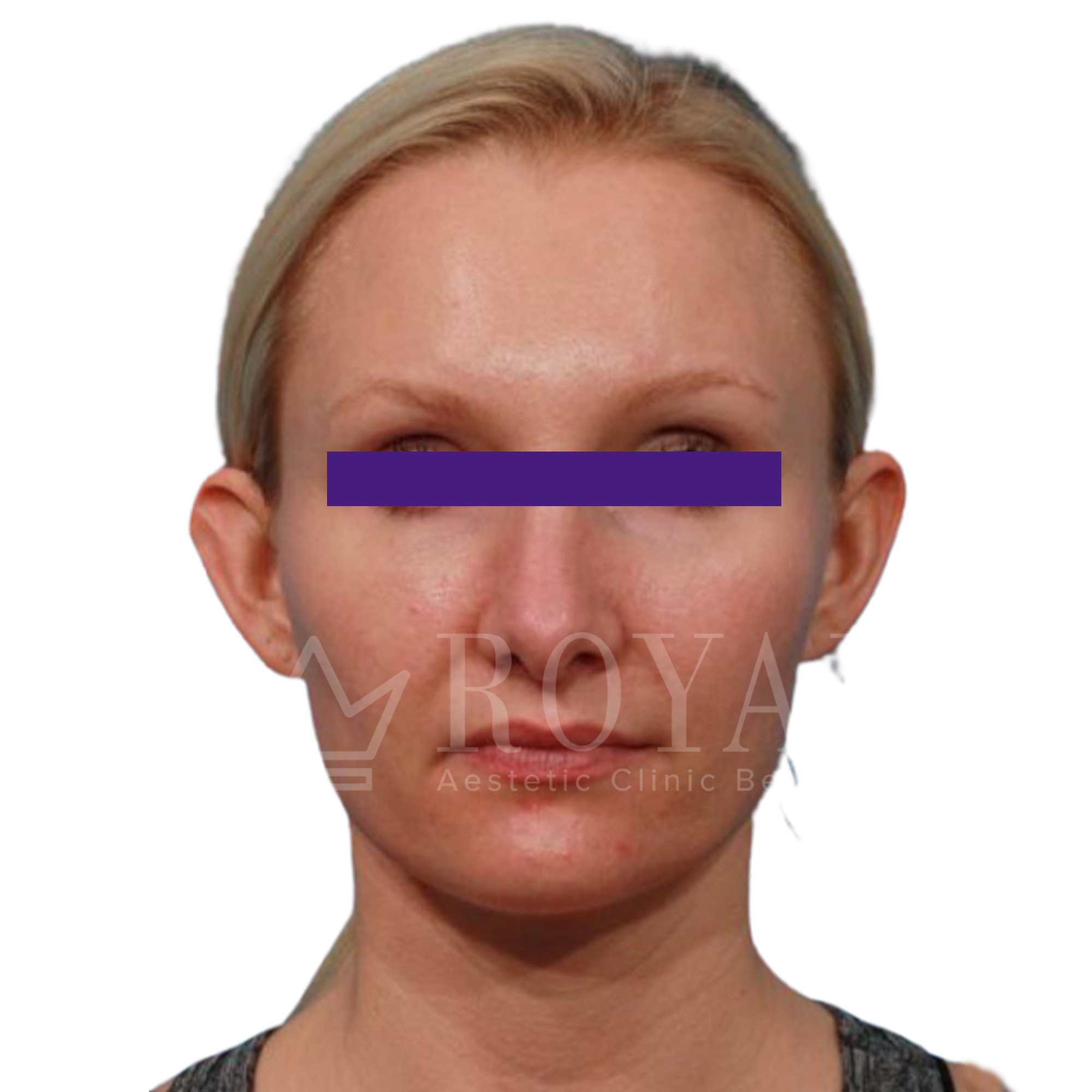 Estetska kirurgija | Prije i poslije