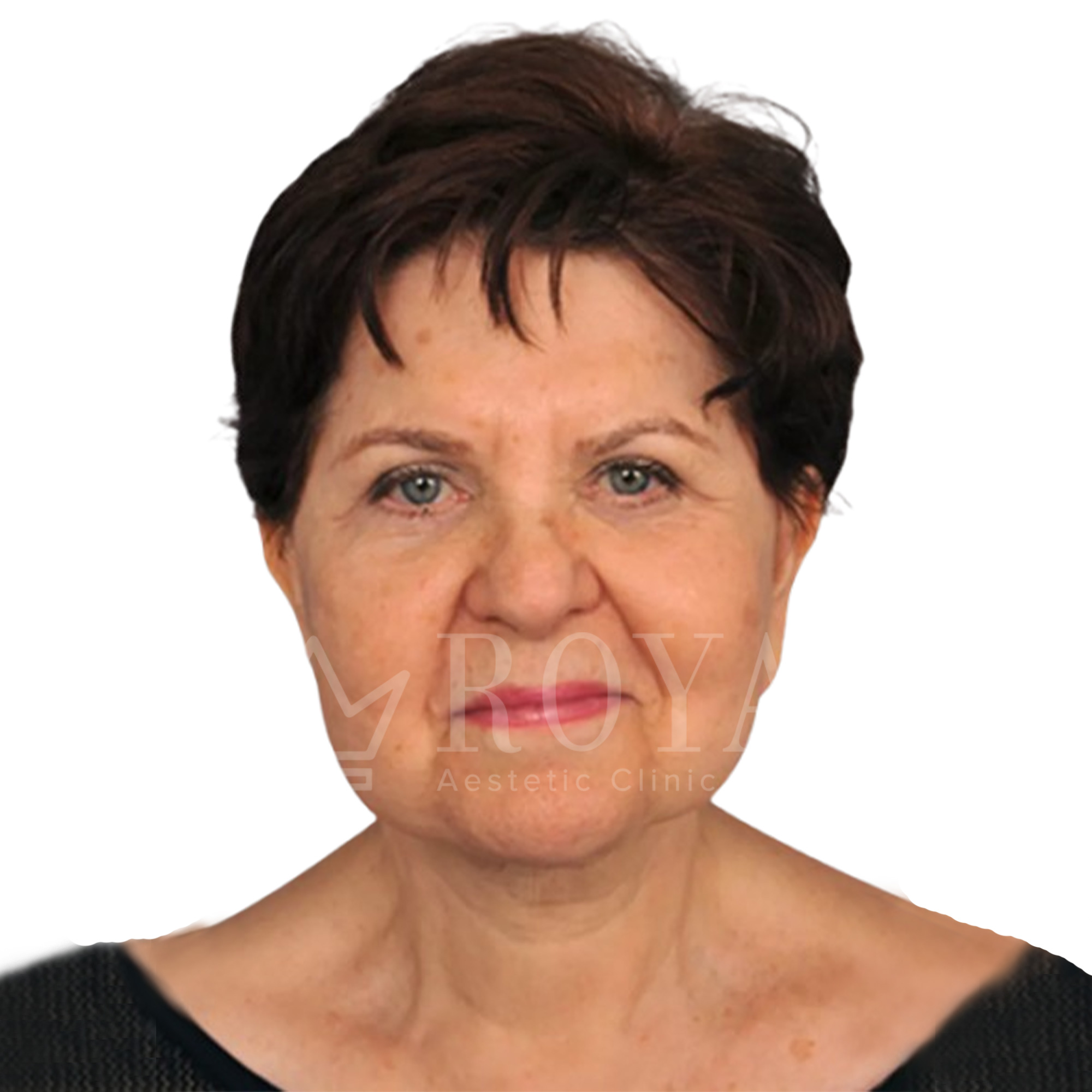 Estetska kirurgija | Prije i poslije