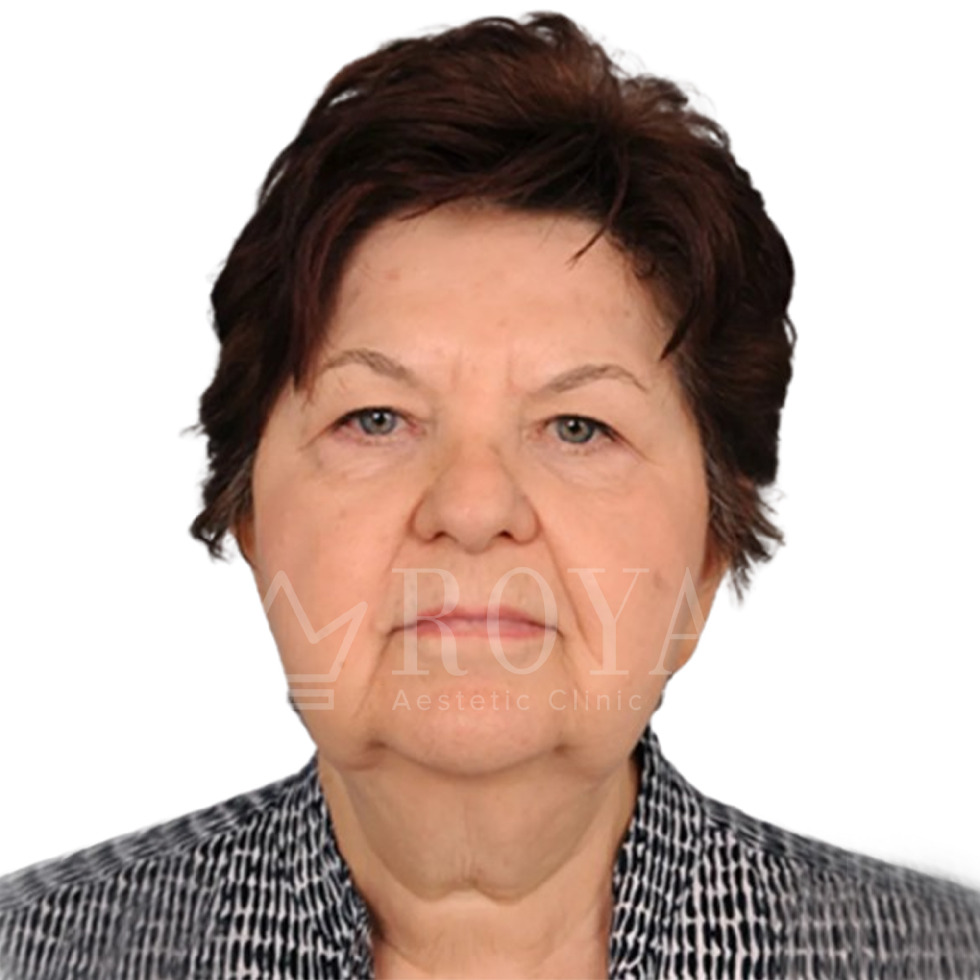 Estetska kirurgija | Prije i poslije