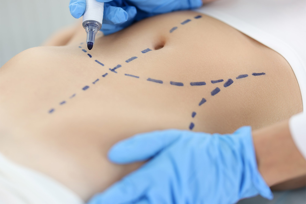 Liposukcija abdomena | Liposukcija abdomena